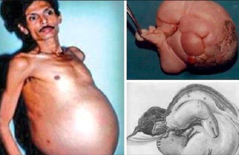 Man who looked pregnant had his twin living inside him for 36 years Vin