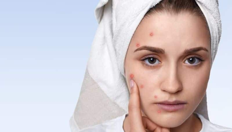 Want flawless skin 7 things to keep in mind to avoid acne gcw eai