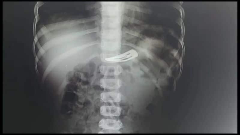 Doctors successfully remove hairpin from stomach of 3-year-old child nagapattinam