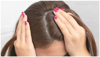 BeautyTips: చుండ్రు తో బాధపడుతున్నారా.. అయితే ఈ విటమిన్ లు లోపమేమో, జాగ్రత్త పడండి!