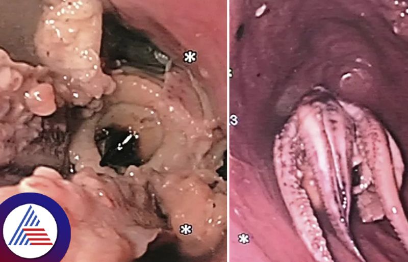 Man Visits Hospital Complaining Of Vomiting, They Find octopus Stuck In His Throat Vin