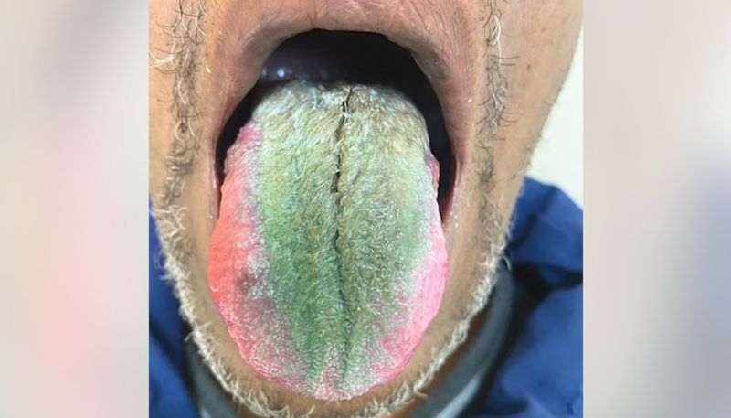 Bizarre Ohio man develops greens and hairy tongue from smoking and antibiotics; see picture snt