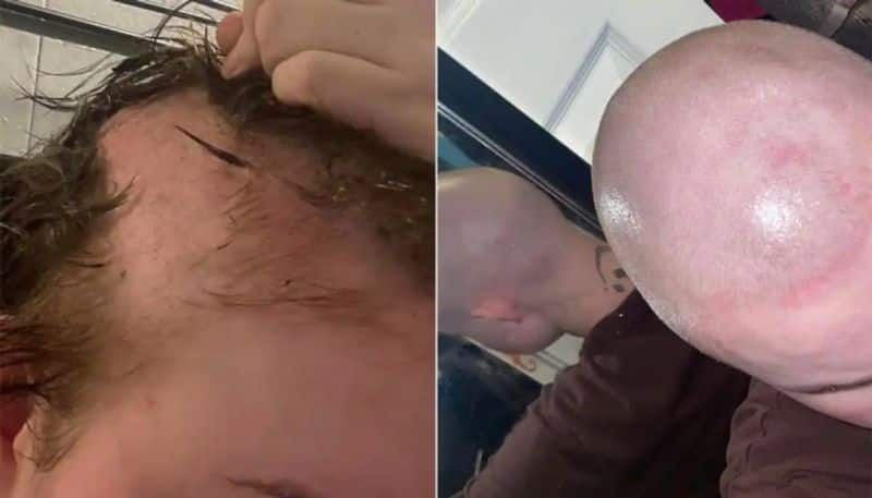 hair extension caused heavy infection on scalp woman shares her own experience hyp