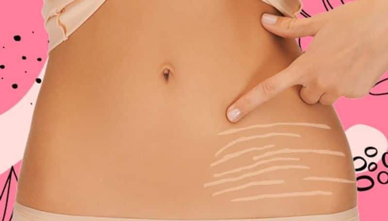 Home remedies: How to removes stretch marks after pregnancy