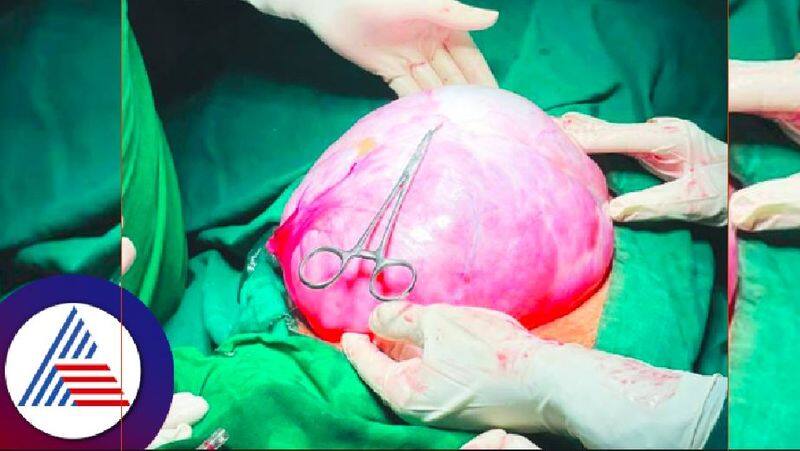 The doctor removed a 3 kg tumor from the woman's stomach belgum rav