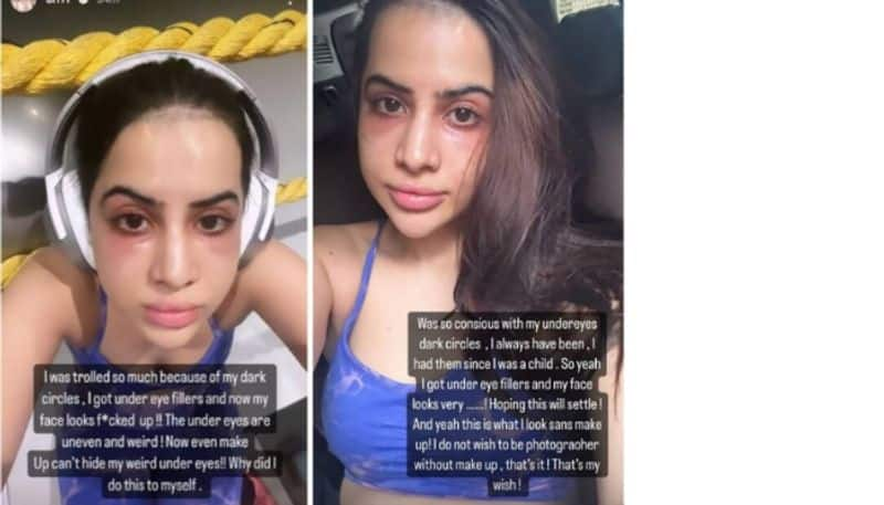 Uorfi Javed Shares Unfiltered Pic After Getting Undereye Fillers azn