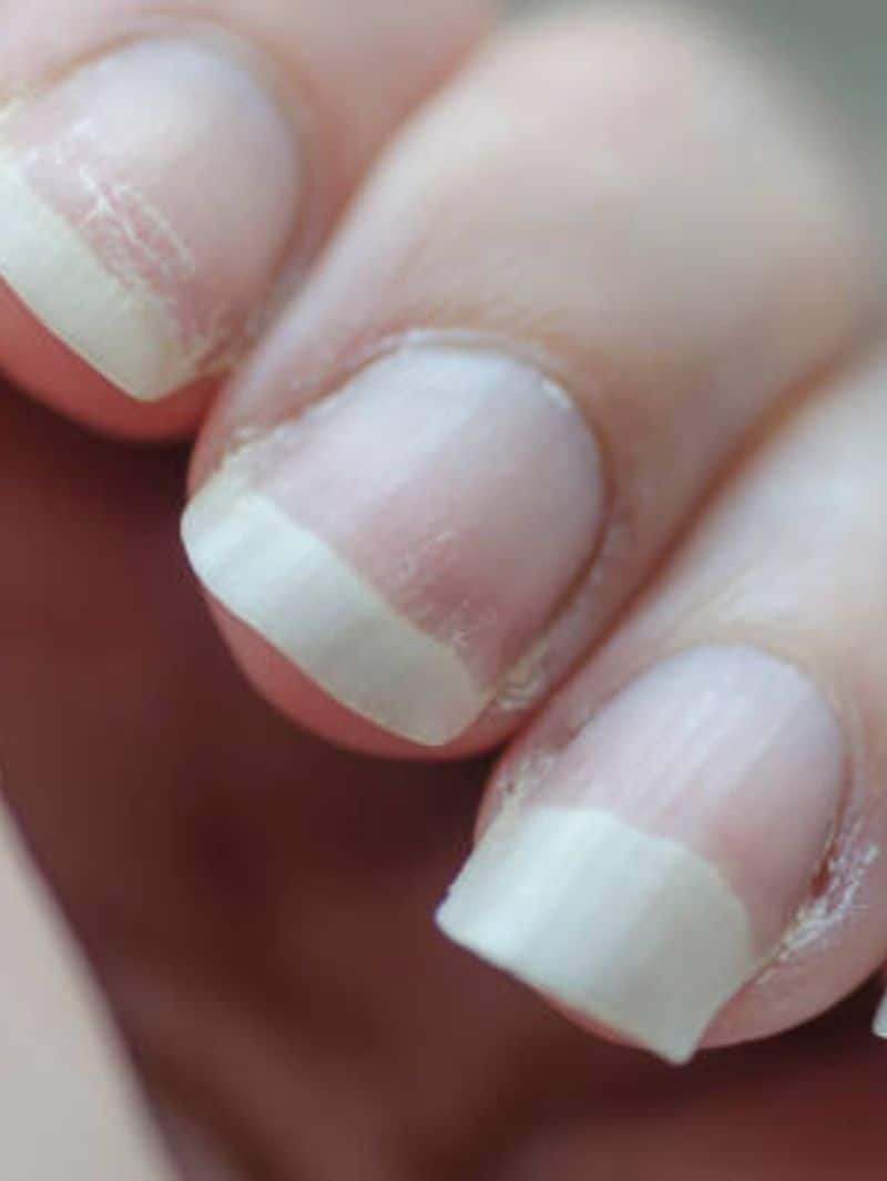 here are the causes of nail brittle and discoloration hyp