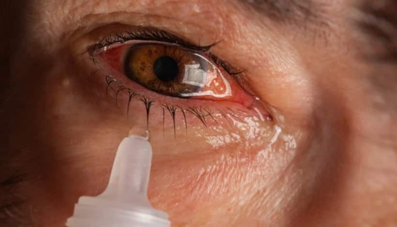 Itchy, red, and watery eyes: Decoding the signs of Conjunctivitis, how to prevent it & more