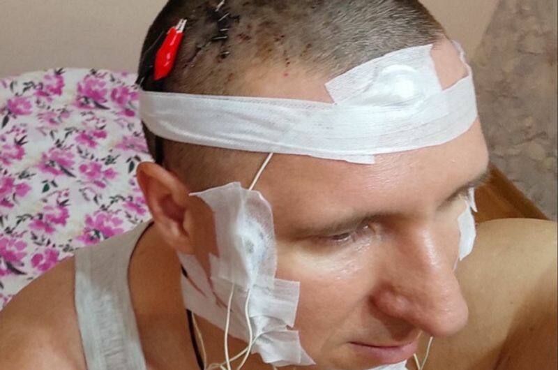 russian man almost dies after drilling chip inside brain in surgery at home ash