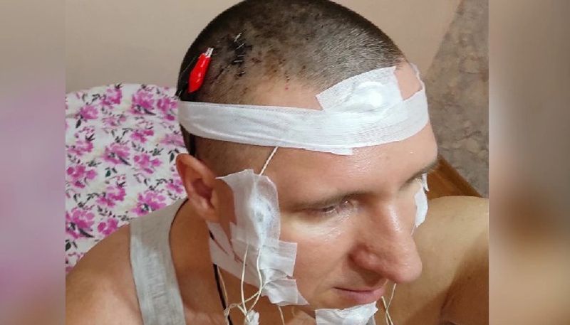 SHOCKING Russian man almost dies after drilling chip inside brain in risky self-surgery; shares pictures snt