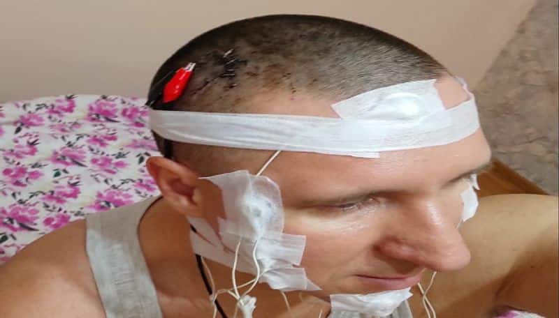 Russian Man Performed himself a brain surgery with driller almost died