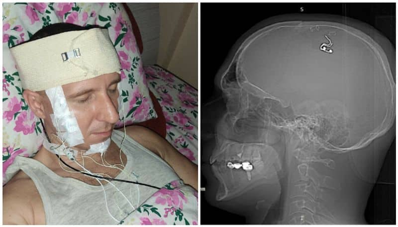 To control dreams man drills and implant 'chip' in his head in Kazakhstan - bsb