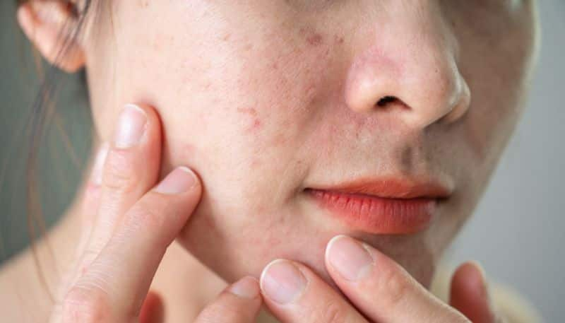 6 home remedies to get rid of acne azn 