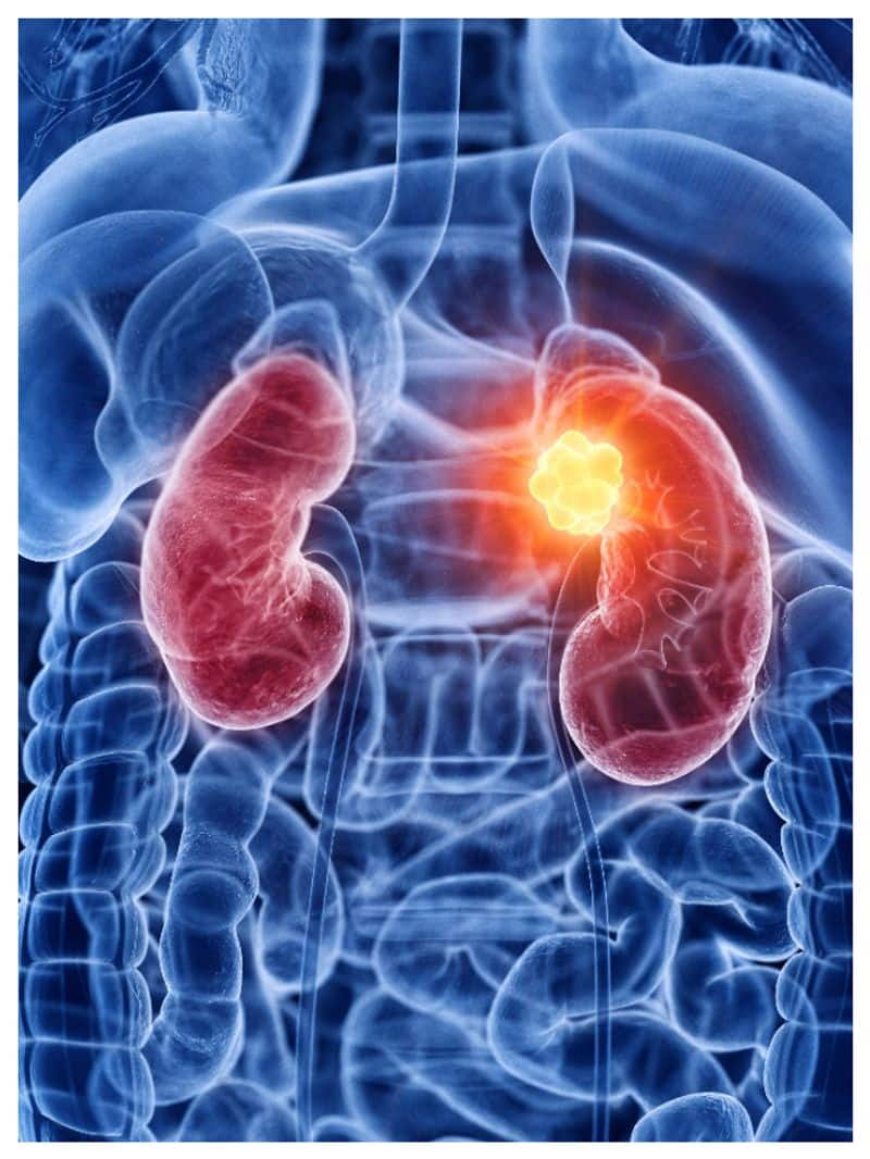 early warning signs of kidney diseases you should not ignore -rse-