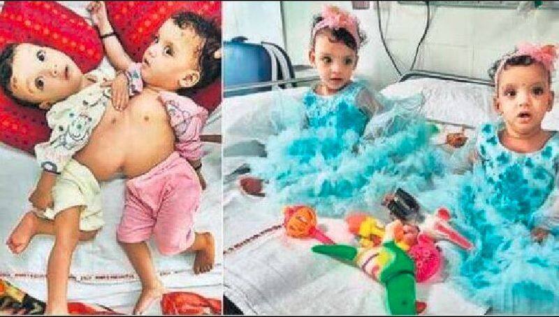 Delhi AIIMS Hospital performed successful surgery on Siamese twins akb