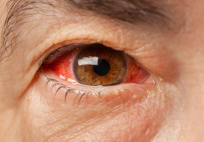 Here are 5 effective ways to prevent conjunctivitis ADC 