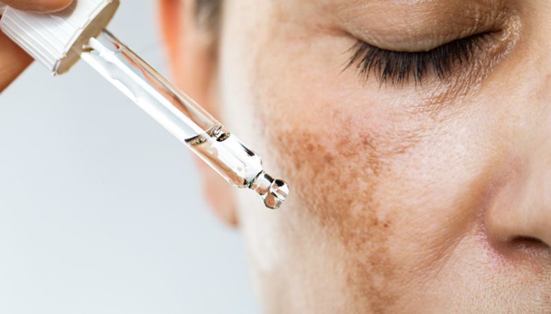 four home remedies to get rid of dark spots azn 