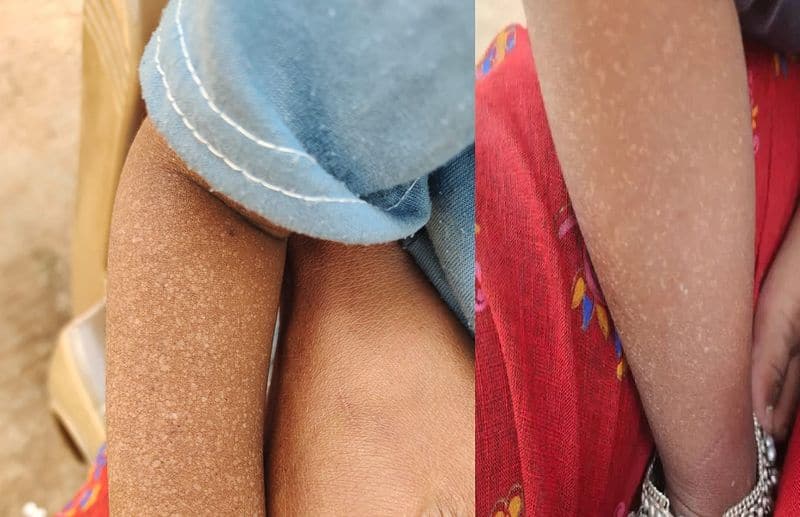 trange skin disease is affecting children in Chamarajanagar gvd