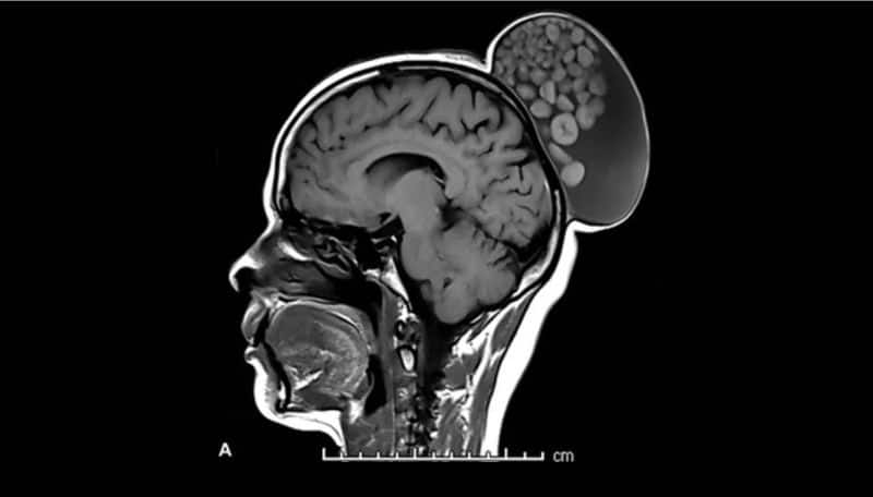 Bengaluru Doctor performed successful Operation on Sack of marbles growing on woman scalp ckm 