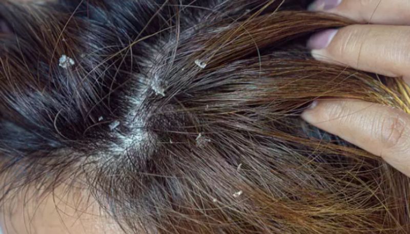 Warning signs of cancer on scalp can be mistaken for dandruff azn 