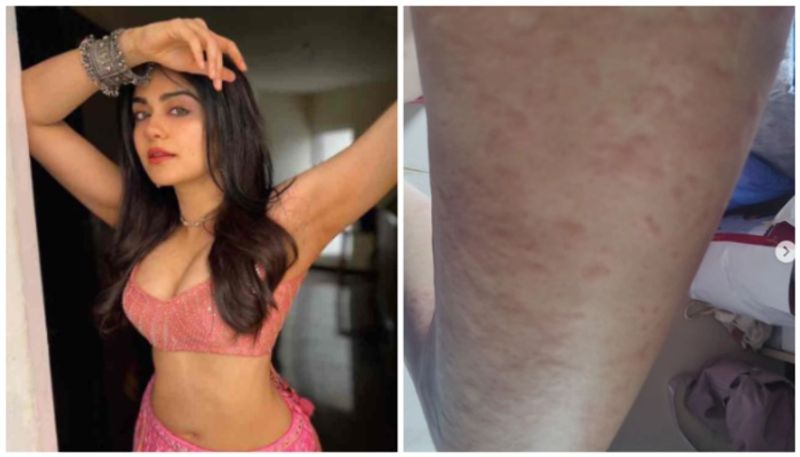 Adah Sharma to take a break for treatment after hospitalisation due to hives, shares health update vvk