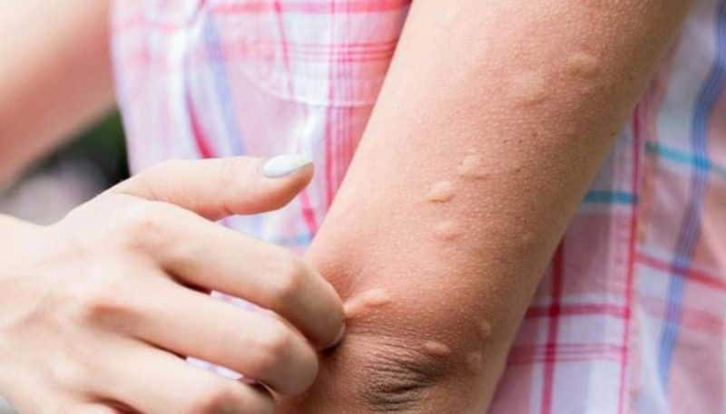 world mosquito day: common mosquito borne diseases rsl