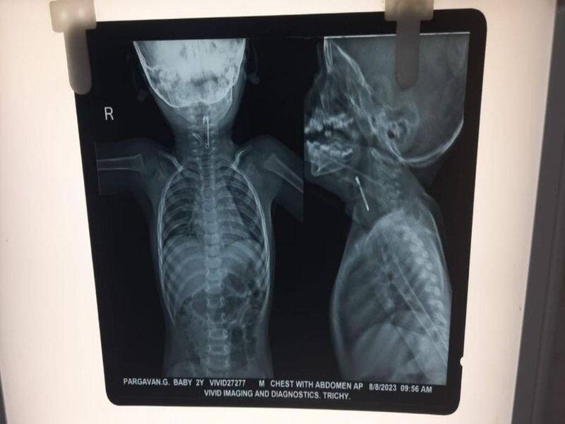 Doctors saved the life of a two year old child who swallowed a pin