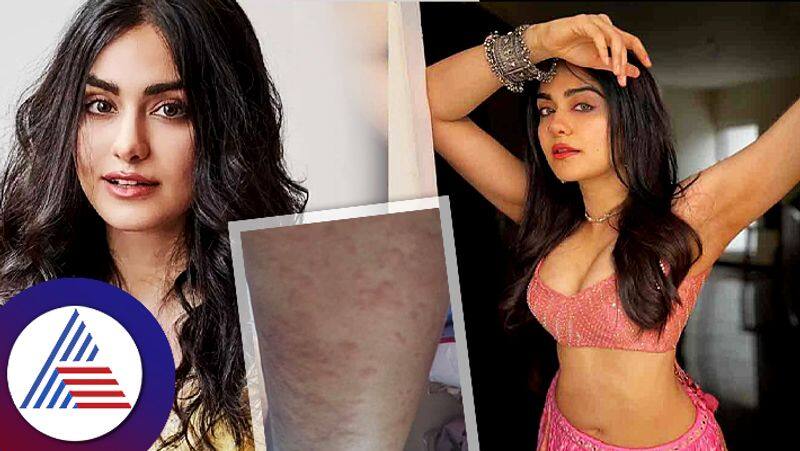 What is hives and its symptoms being suffered from Keral story actress Adah Sharma pav