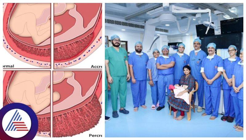 Successful complex placenta accreta spectrum procedure surgery at KMC Hospital first time in karnataka gow