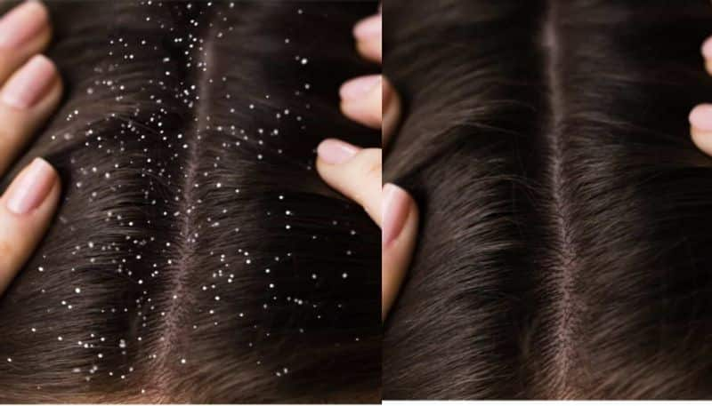 best 6 hair packs to get rid of dandruff azn 