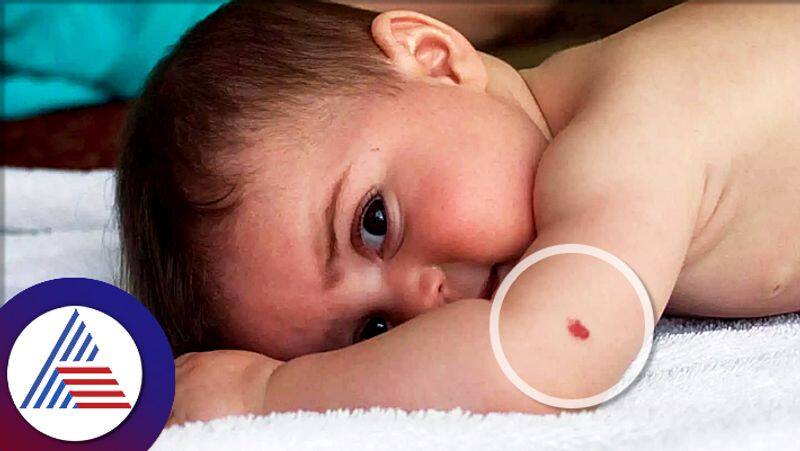 Birthmark on body reveals your personality pav 