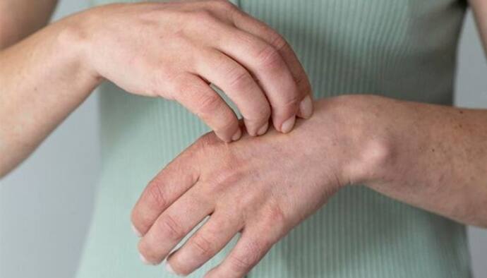 Psoriasis
