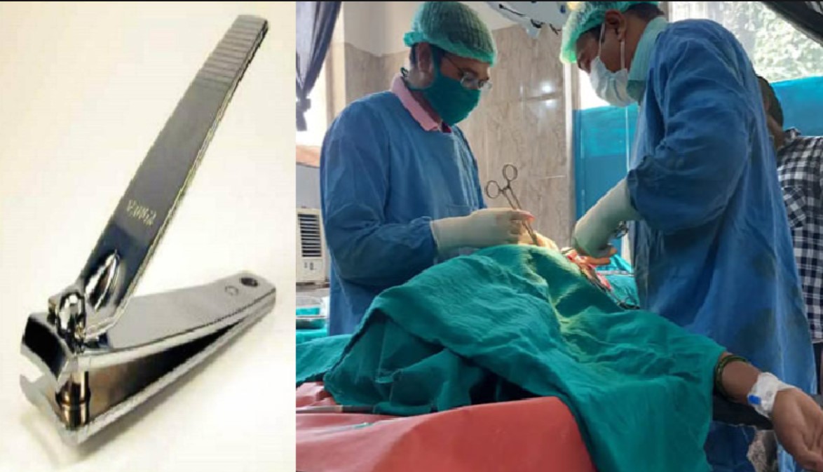 Bengaluru doctors remove nail cutter from man stomach after 8 years anm