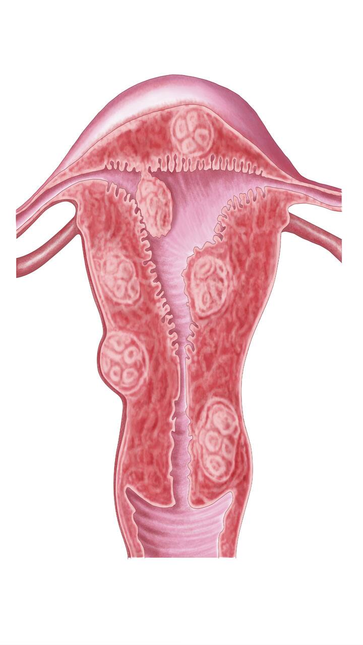 ladies beware women aged 30 and above are mostly affected by uterine fibroids here are the reasons in tamil mks