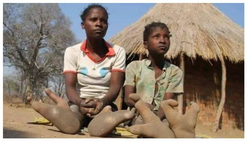 Ostrich Foot Syndrome Zimbabwe Vadoma People Famous For Ectrodactyly Genetic Disorder roo