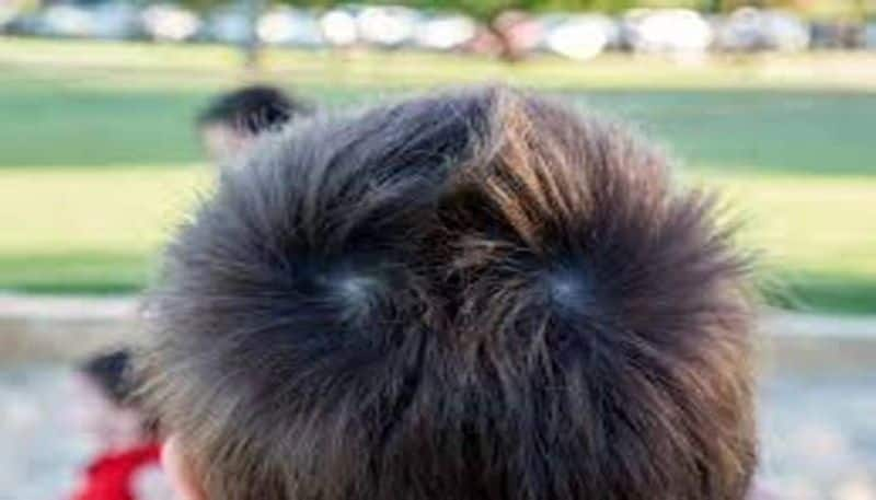  myths and scientific reasons behind double whorl in head rsl