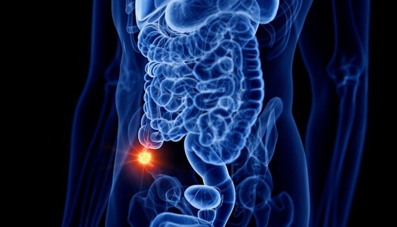 What is appendix cancer? Know the common symptoms and recognise the warning signs RBA