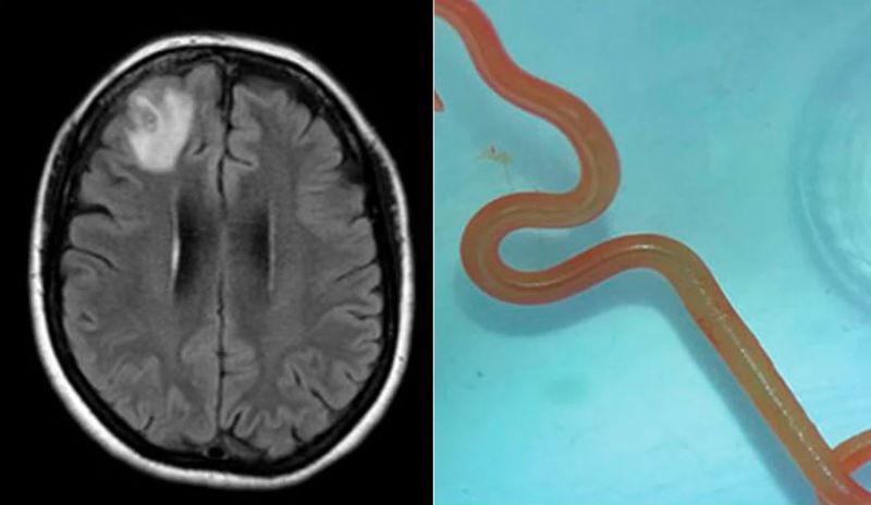 A Australia woman suffering from depression had an 8 cm long live worm in her brain akb