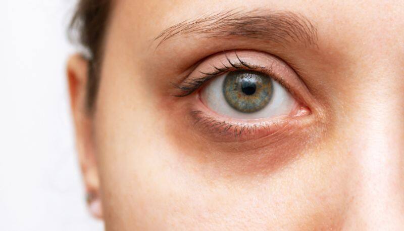 four vegetables to get rid of dark circles azn 