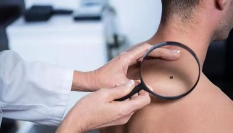 melanoma causes symptoms and prevention azn