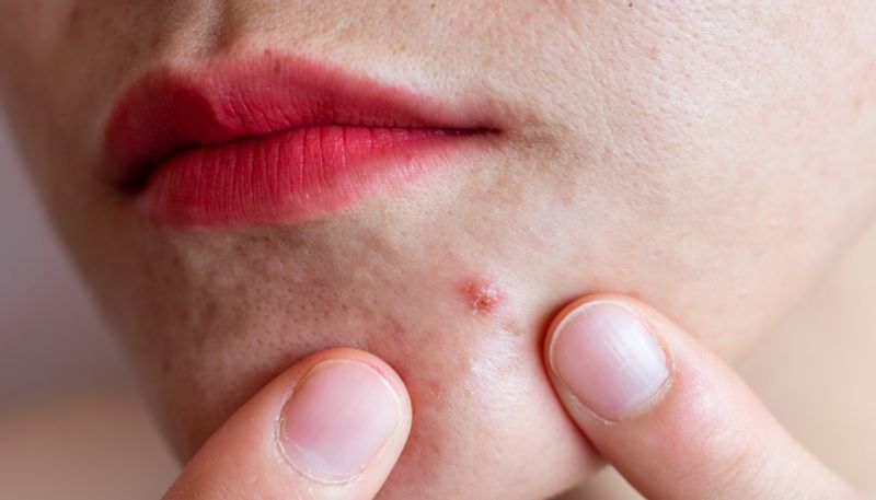 Try these Tips to Help Overcome acne azn 