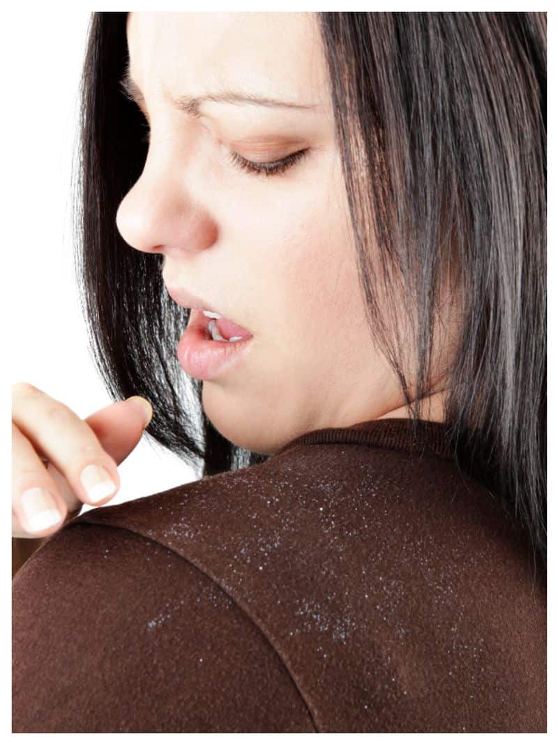 tips to remove dandruff easily-rse- 