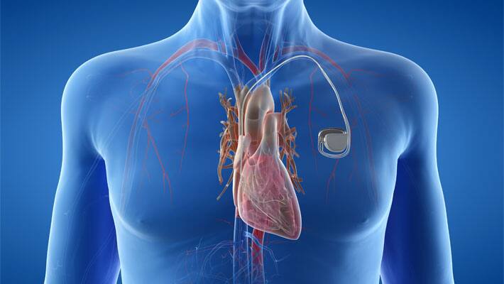 pacemaker