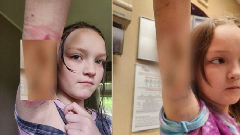 9 years old girl complains of a pinch then discoverd by mother that Spider Bite Quickly Spread zrua