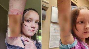 9 years old girl complains of a pinch then discoverd by mother that Spider Bite Quickly Spread zrua