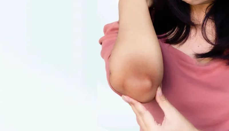 tips to get rid of dark elbows azn