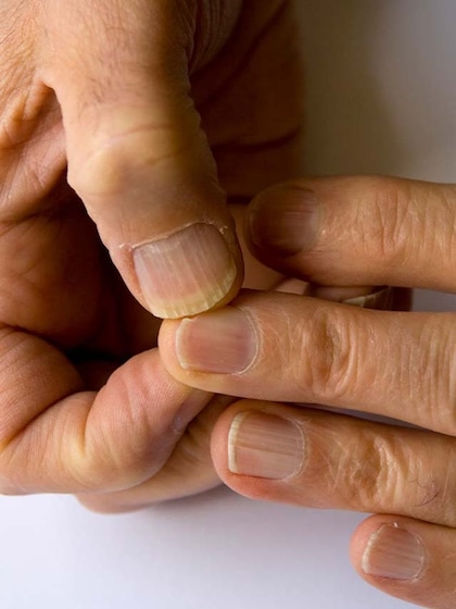 Damage to natural nails