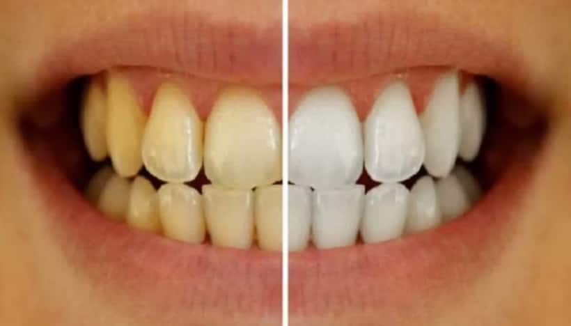 Teeth Whitening: పళ్లపై పసుపు రంగు పోయి తెల్లగా మారాలంటే ఇదొక్కటి పెడితే చాలు!