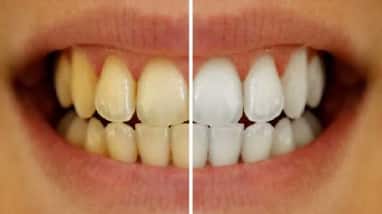 Get Rid of Yellow Teeth with Baking Soda Get Rid of Yellow Teeth with Baking Soda