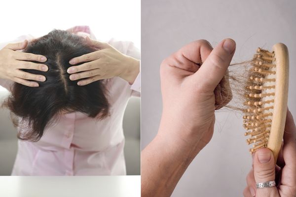 ड्राय स्कॅल्प म्हणजे नेमके काय? ड्राय स्कॅल्प म्हणजे नेमके काय?